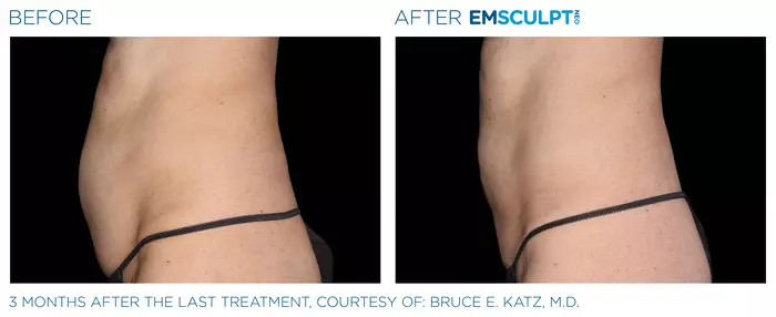 Abdomen-Before-After-women-2