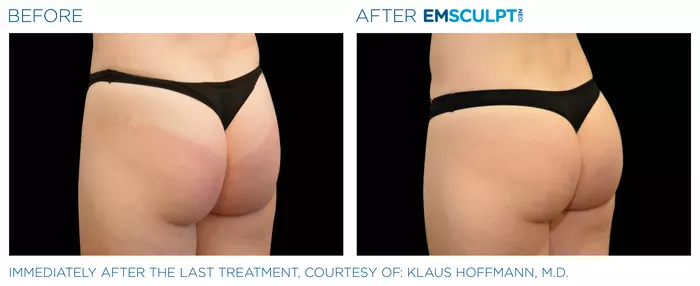 Emsculpt_Neo_female-buttock-04