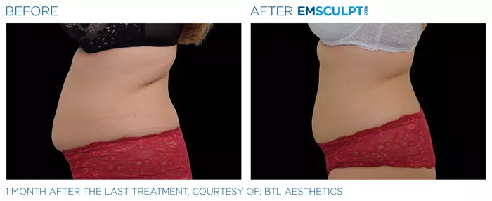 abdomen-before-after-female-3