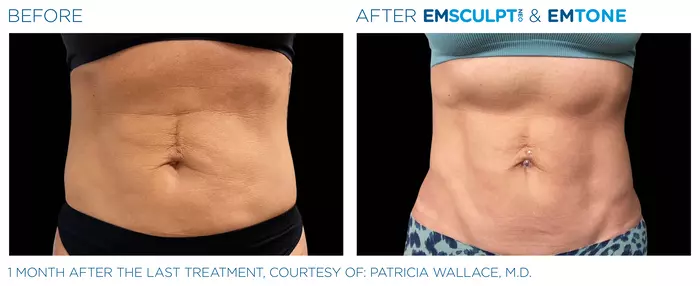 abdomen-before-after-female-sixpack