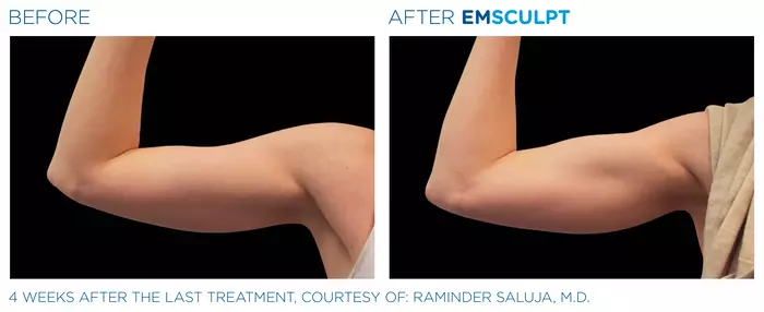 arms-before-after-man-2