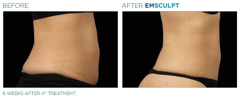 emsculpt-neo-before-after-women