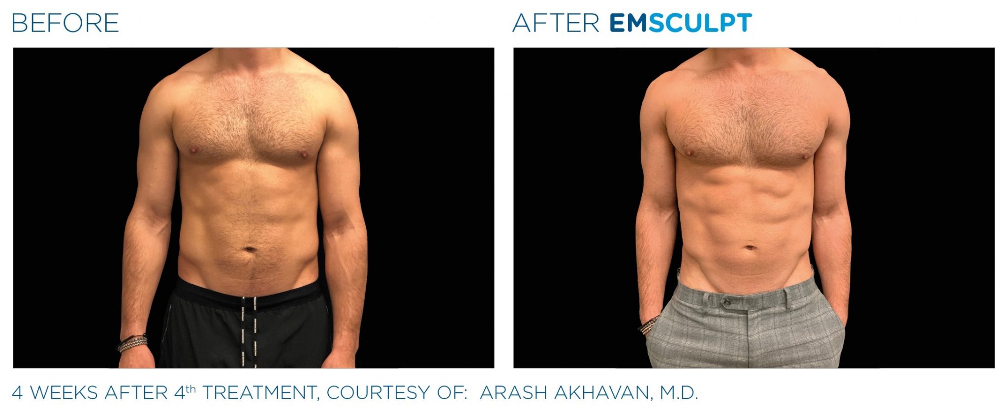 emsculpt-neo-before-and-after-results-men-2048x838