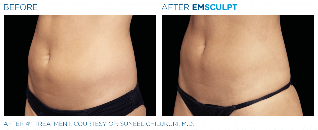 emsculpt_pic_ba-card-female-abdomen-011_enus100-1024x419-1